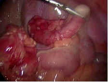 Inflamed Appendix